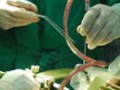 世界首例干细胞气管移植手术完成