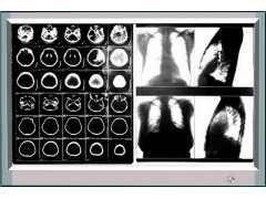 LED 观片灯  观片灯