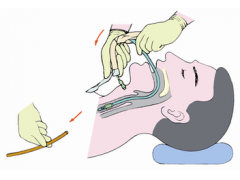喉罩气道导管使用方法及注意事项