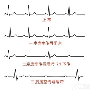 看心电图揪「拦路虎」：谈谈房室传导阻滞