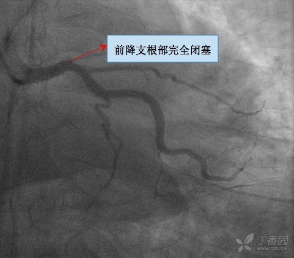 血栓抽吸术：如何有效防治致栓塞风险？