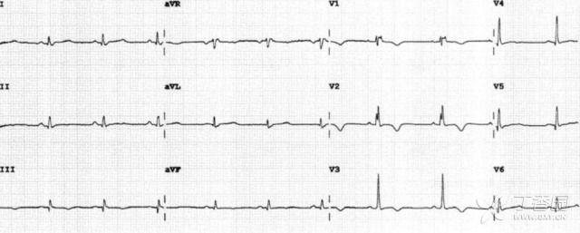 罕见危重症心电图：这 8 种波形你能识别几种？
