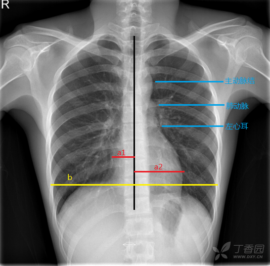 扒一扒 那些与心血管疾病密切相关的异常胸片征象