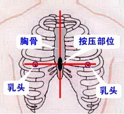 精狠准急救八诀：基础心肺复苏与自动体外除颤器用法