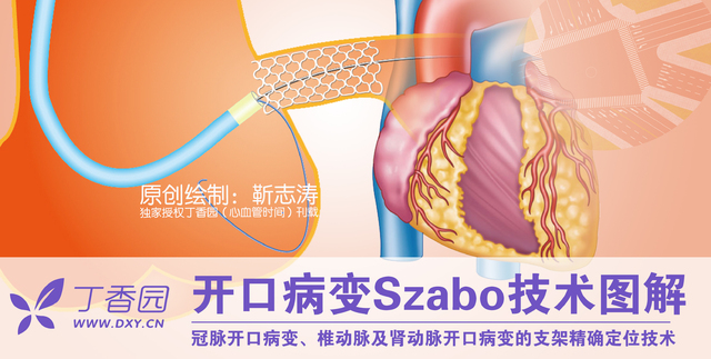 图解冠脉介入：开口病变 Szabo 技术详解