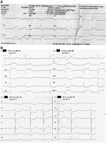 反常栓塞同时引起 STEMI 和肺动脉栓塞一例