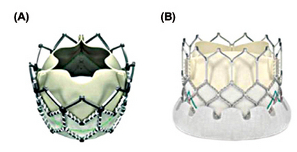 盘点2014年经导管主动脉瓣置换进展