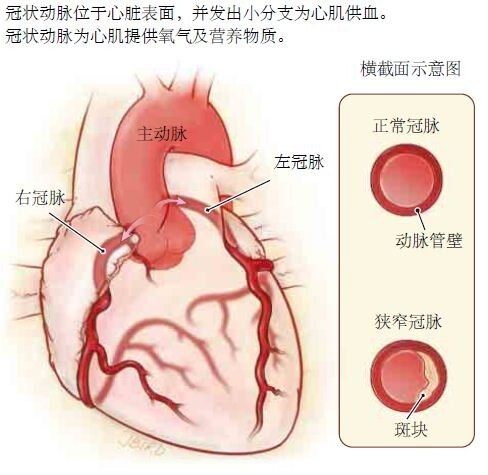 如何检测「沉默型」冠心病？