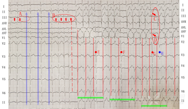 宽 QRS 波如何鉴别诊断？一张心电图掌握技巧