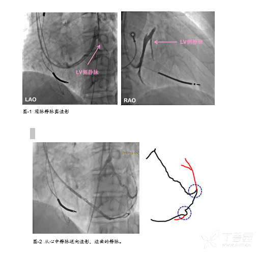 安贞医院：应用冠脉逆向技术完成 1 例高难度 CRT-D 手术