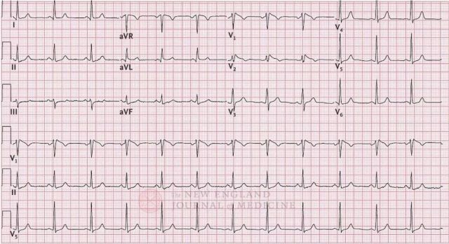 NEJM 丨 ICD 植入又取出还放了支架，她的坎坷经历究竟为哪般？