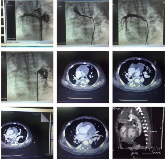 病例分析：合并室缺及大型体肺侧支的 IV 型肺动脉闭锁治疗新理念