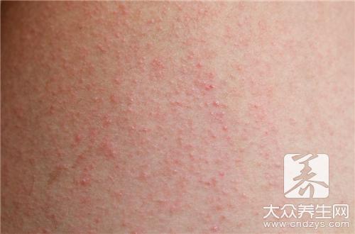 湿疹艾灸有用吗