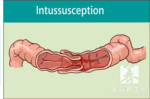 小孩套肠是什么引起的