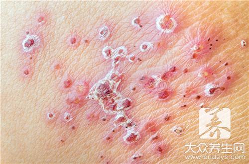 湿疹用高锰酸钾