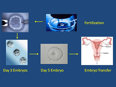 为什么会有人做试管婴儿呢?试管婴儿有几种
