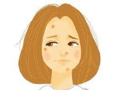 脸上起痤疮什么原因引起的?